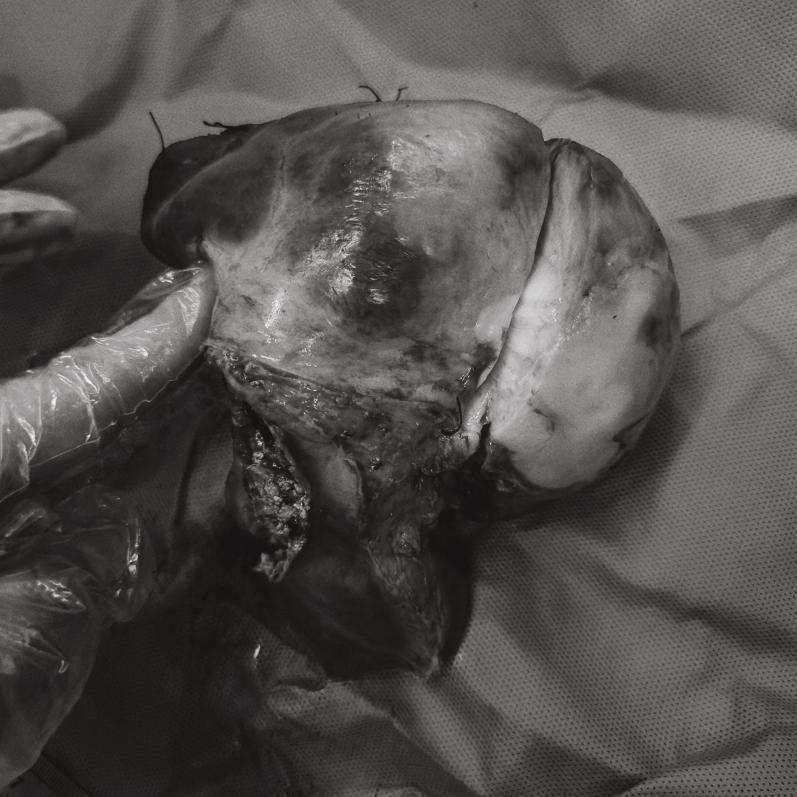 外科手术珠穆朗玛峰,肝胆外科的珠穆朗玛峰