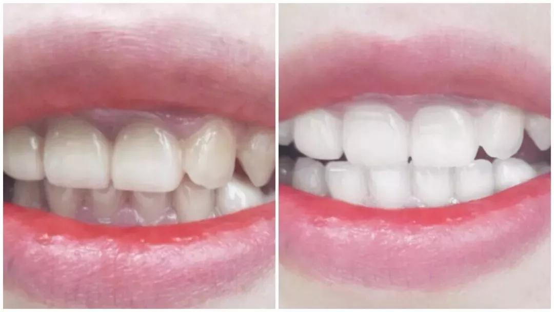 李沁牙膏真的有效果吗,李沁的黄牙变白了