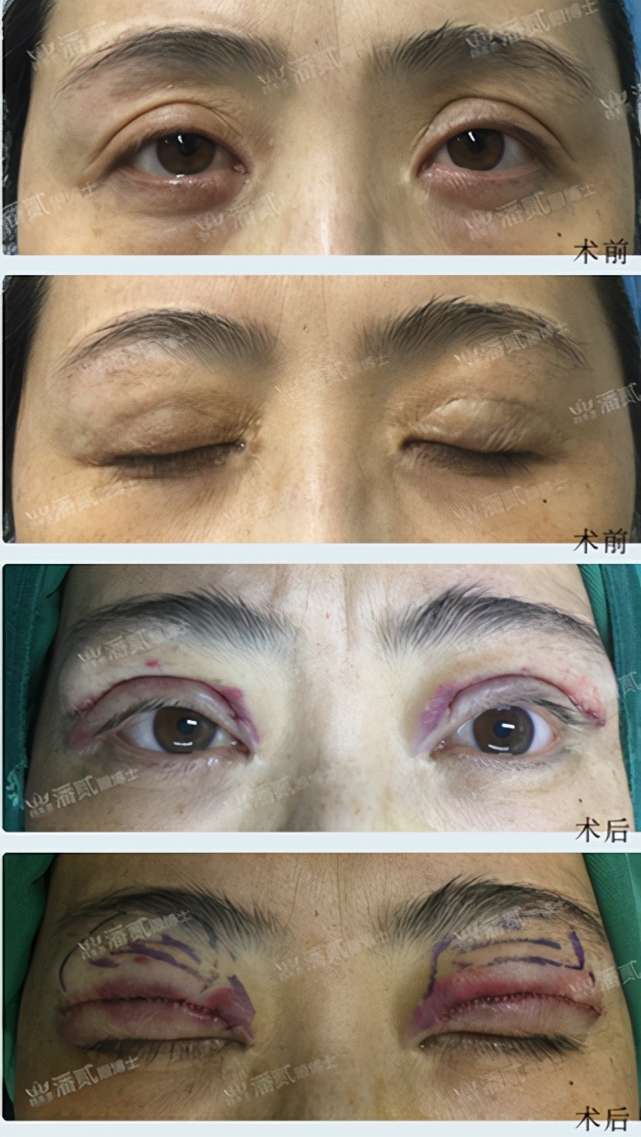 高难度修复双眼皮宽改窄恢复期,高难度双眼皮修复案例