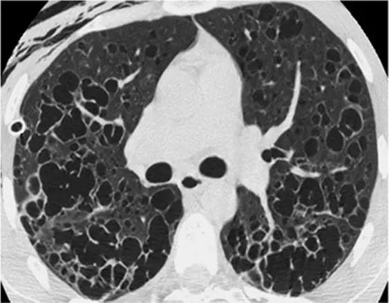 间质性肺疾病看病经验分享,分享肺腺癌临床实验的例子