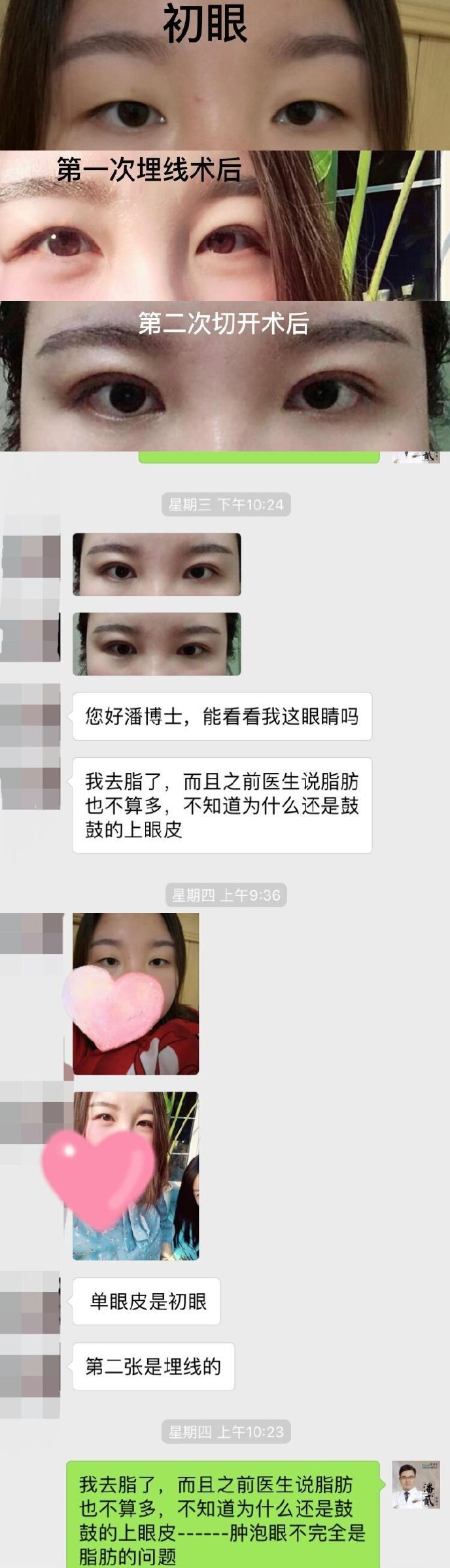 双眼皮手术科普：割双眼皮七大常见误区，您中招了几个？