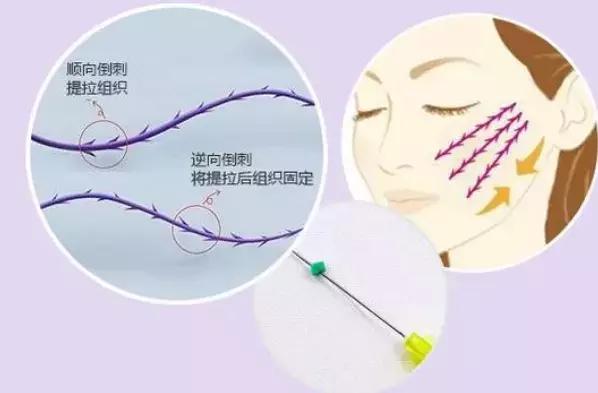 脸部蛋白线提拉紧致多久做一次,线雕蛋白线吸收后脸会怎么样