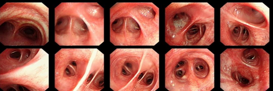 56岁男性发现双肺数百个结节,肺部肿块伴胸腔积液