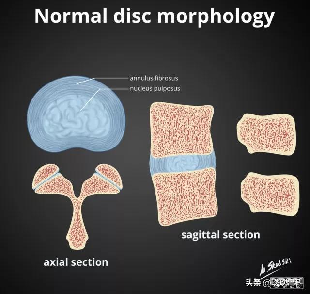 图解腰椎间盘突出,椎间盘髓核膨出图
