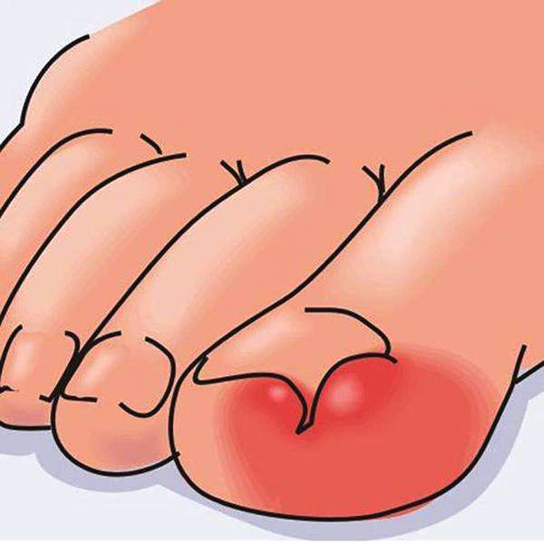 得甲沟炎最有效的处理方法是什么,甲沟炎怎么初期治疗才能彻底根除