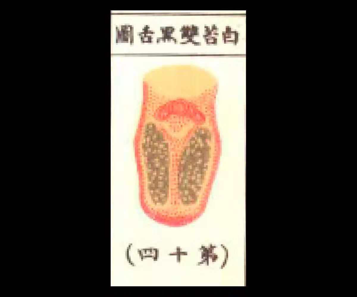 白苔黄厚有齿痕,白苔黑舌
