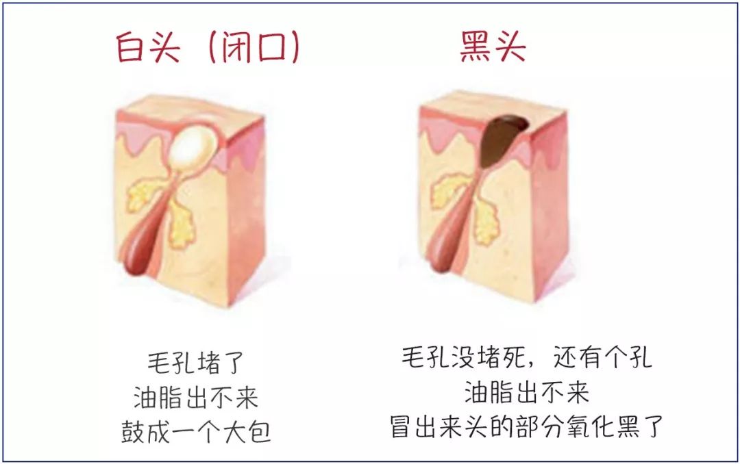护肤解决痘痘和闭口,护肤毛孔粗大闭口怎么补救