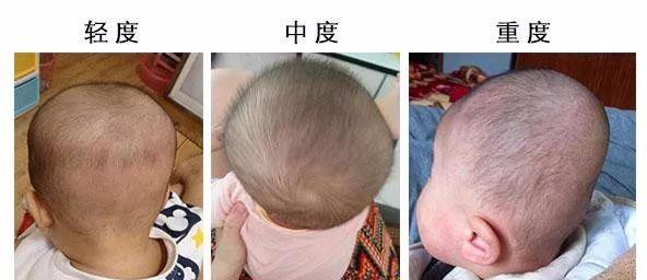 宝宝头型睡扁了能恢复吗,宝宝头型睡偏了长大后会改善吗
