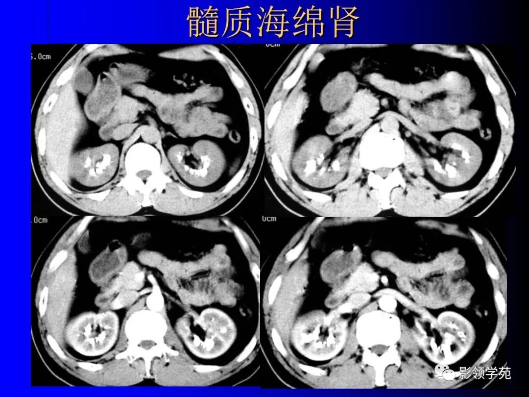 肾脏囊性肿块的影像学特点,肾脏典型病理图片及解析