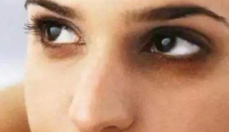 黑眼圈为什么一直不退,肾阳虚黑眼圈常年不退