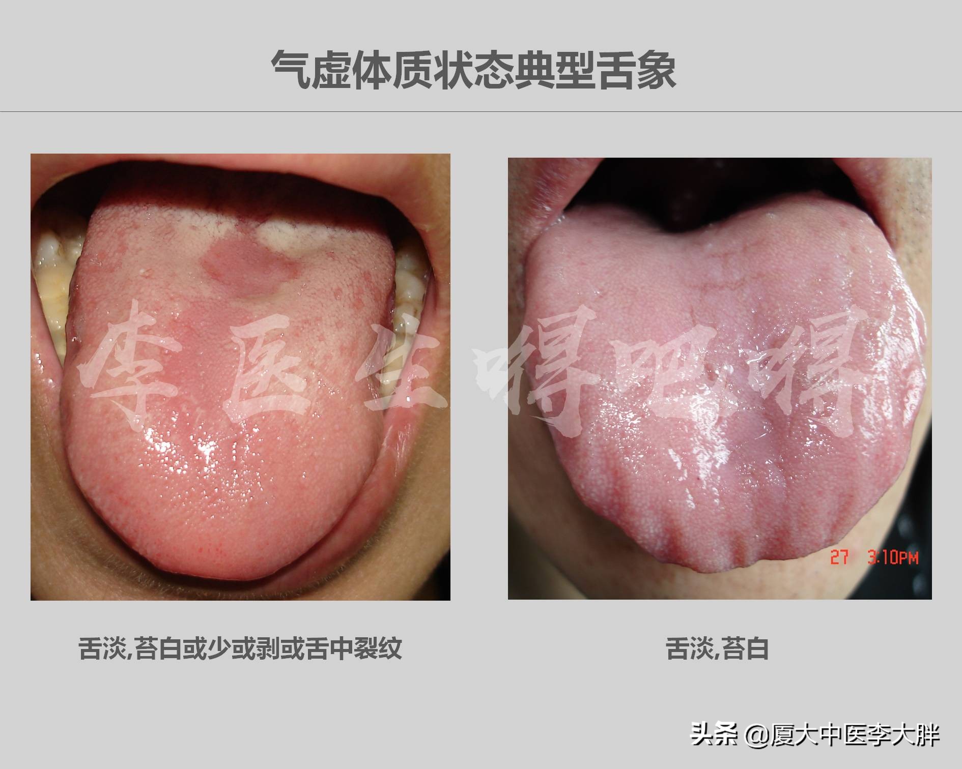 女人气虚怎么调,调气虚的中成药