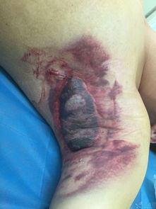 手术治疗腋臭到底好不好,腋臭手术后如何恢复治疗