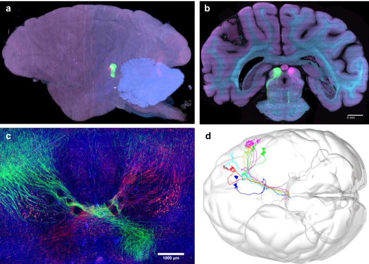 脑科学日报：“老年痴呆”要改名了？青年型痴呆的发病率超乎想象