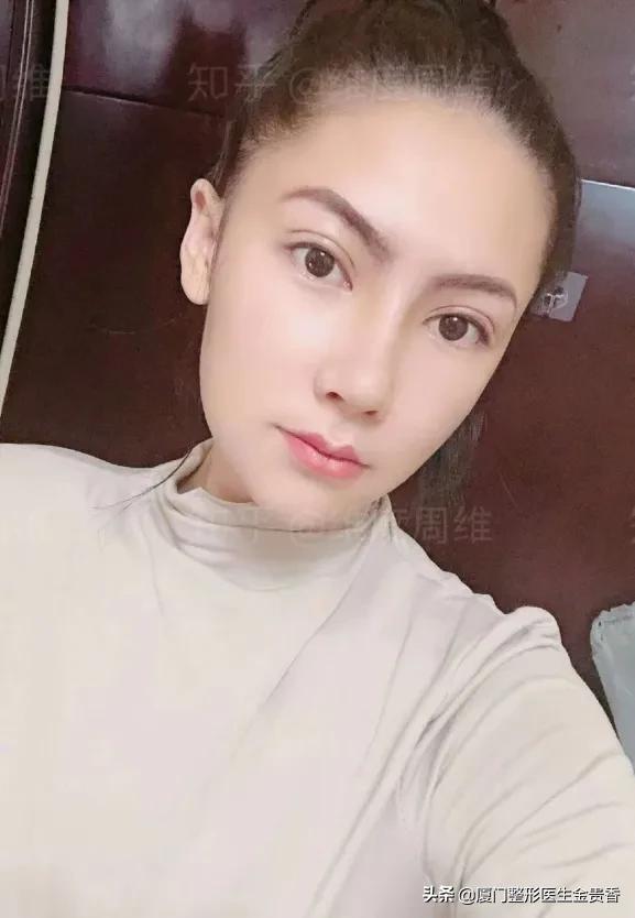 鼻子变挺的方法,想要鼻子变挺去哪里好