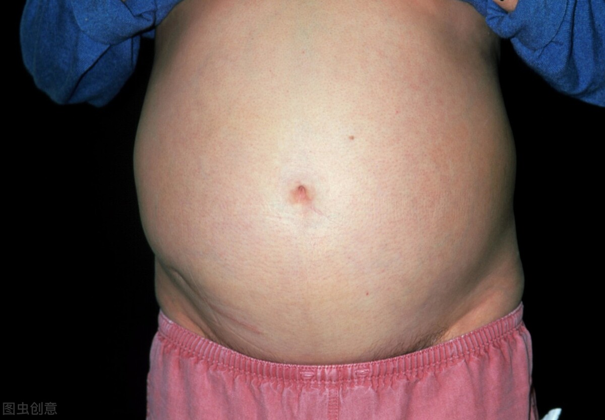 肝硬化腹水与心功能不全腹水,肝硬化顽固性腹水最有效方法