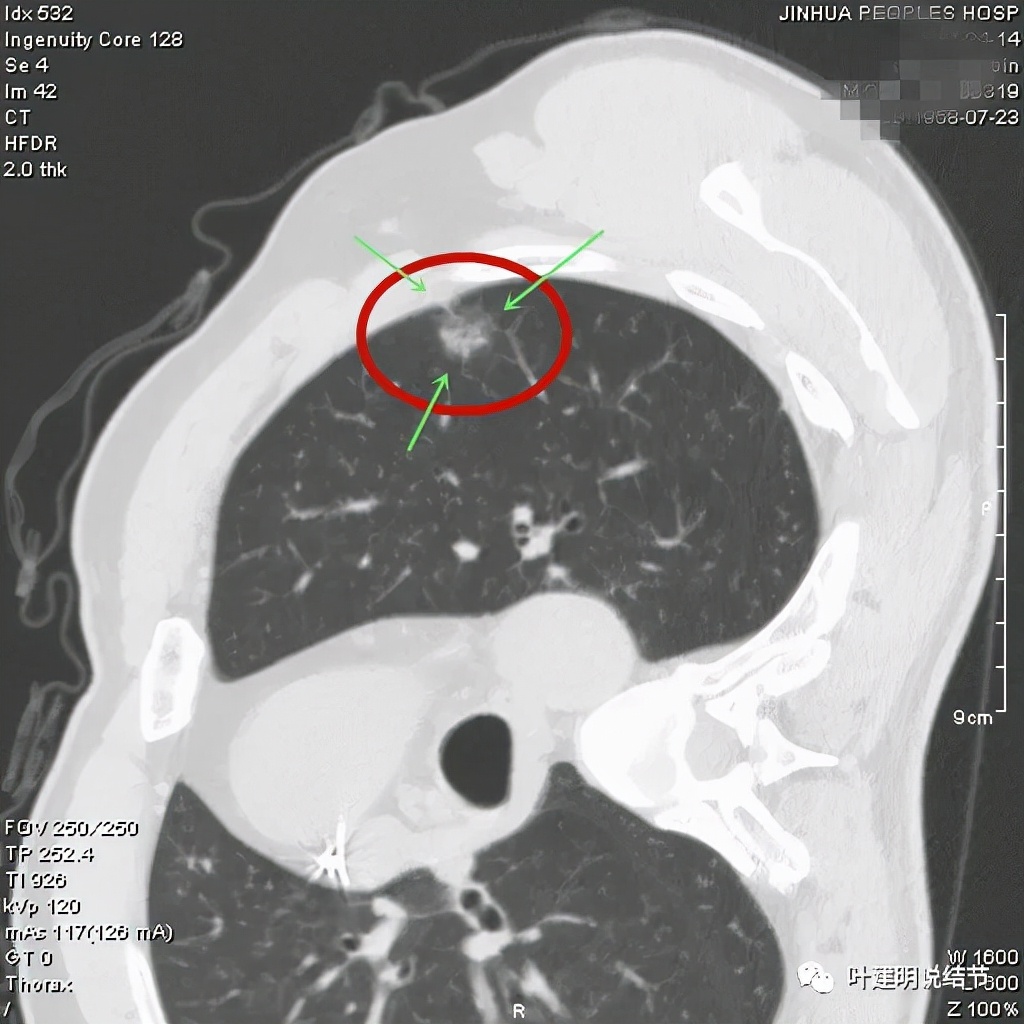 怎样从病理报告看是不是原位癌,原位腺癌切除子宫要开刀吗