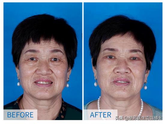 双眼皮提眉一起做半年效果,双眼皮提眉一起做几天能热敷