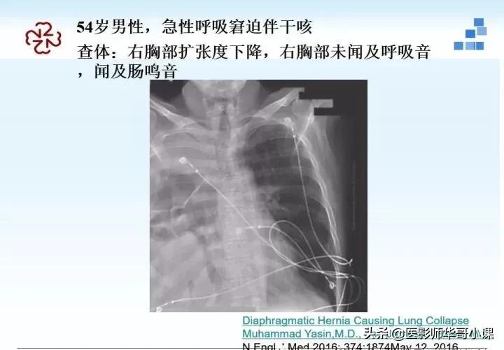 「精品课件」胸部膈肌的解剖及常见病变影像的表现