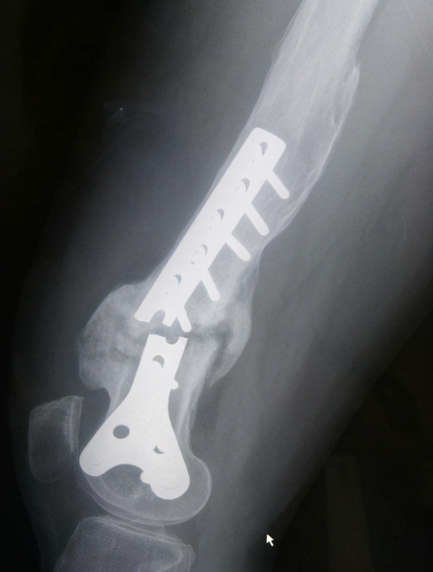 骨折上的钉还用取出来吗,骨折放的钢板是铁的吗