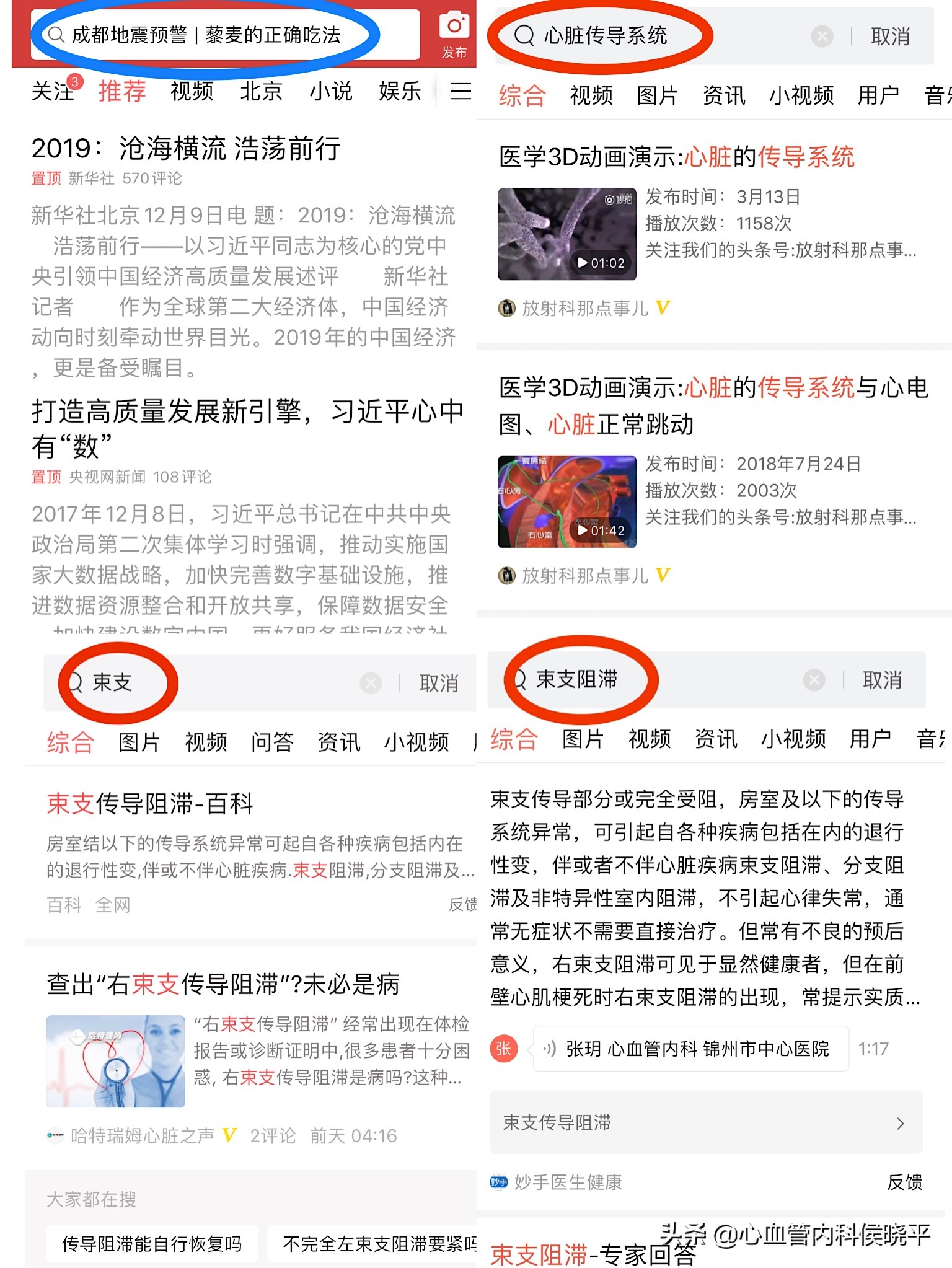 心电图查出心脏有阻滞是怎么回事,心电图查出右束支传导阻滞