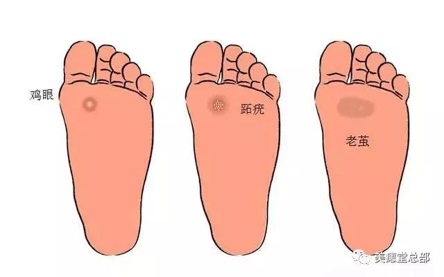 脚底鸡眼和跖疣的区别,挤鸡眼和跖疣的区别