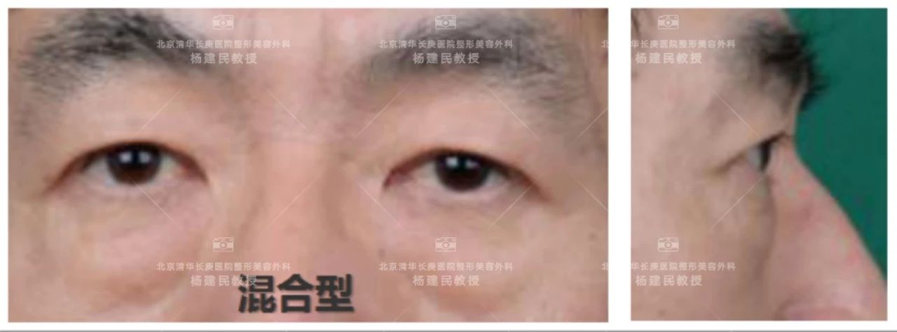 如何分清自己是哪种类型的眼袋,怎么看是哪种类型的眼袋