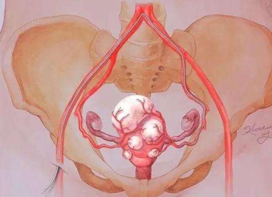 没有了子宫对身体有什么影响,没了子宫会有什么感觉