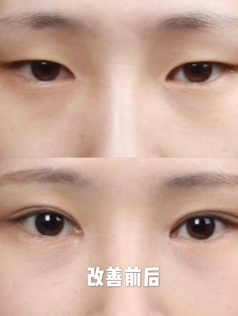 眼角开的形状不自然能修复么,眼角开大了恢复后会变小吗