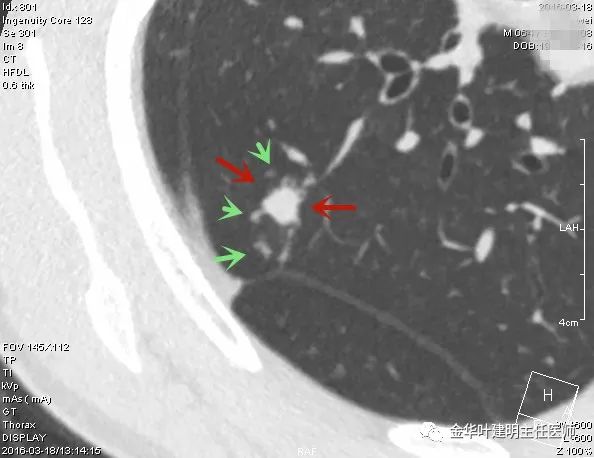 叶建明谈实性结节,叶建明肺实性良性结节会变癌症吗