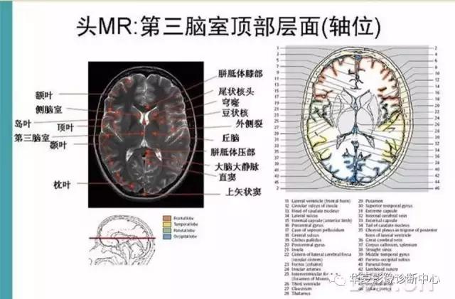 电子版头颅ct与mri断层解剖,头颅mri血管解剖与分段详解