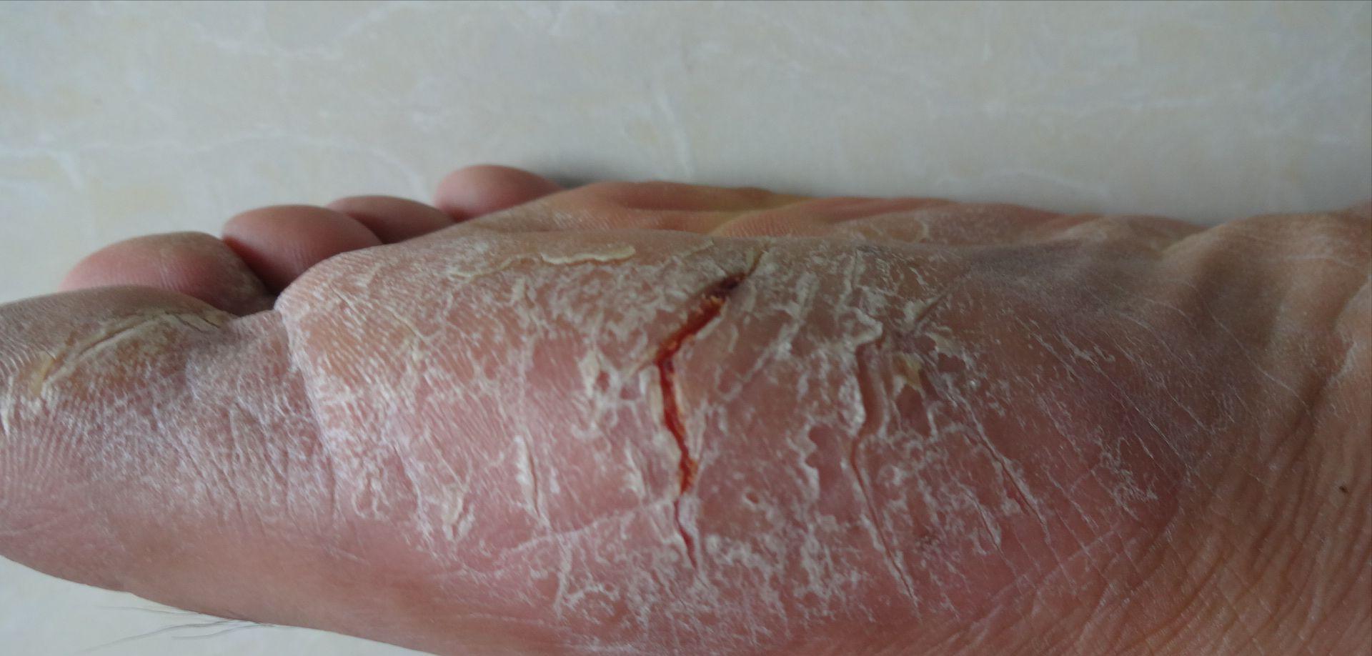 手脚湿疹和癣的区别,手足癣干裂脱皮怎么治