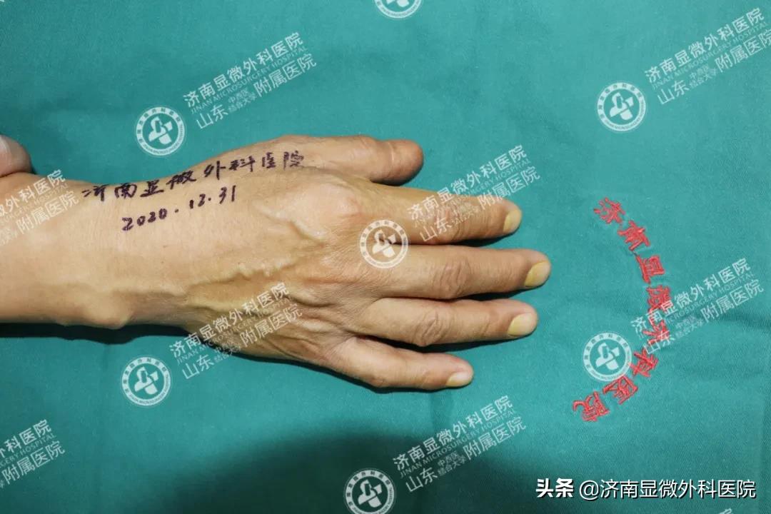 手指少了一块肉怎么处理,手指少了一截