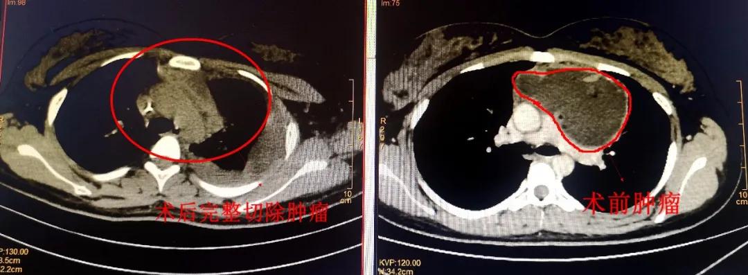 胸外科切良性肿瘤,微创手术切瘤