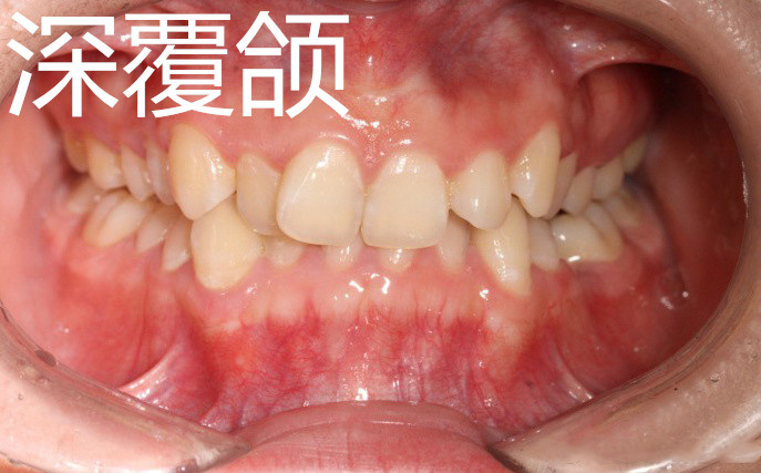 30岁还可以牙齿矫正吗,30岁牙齿矫正一般多少钱