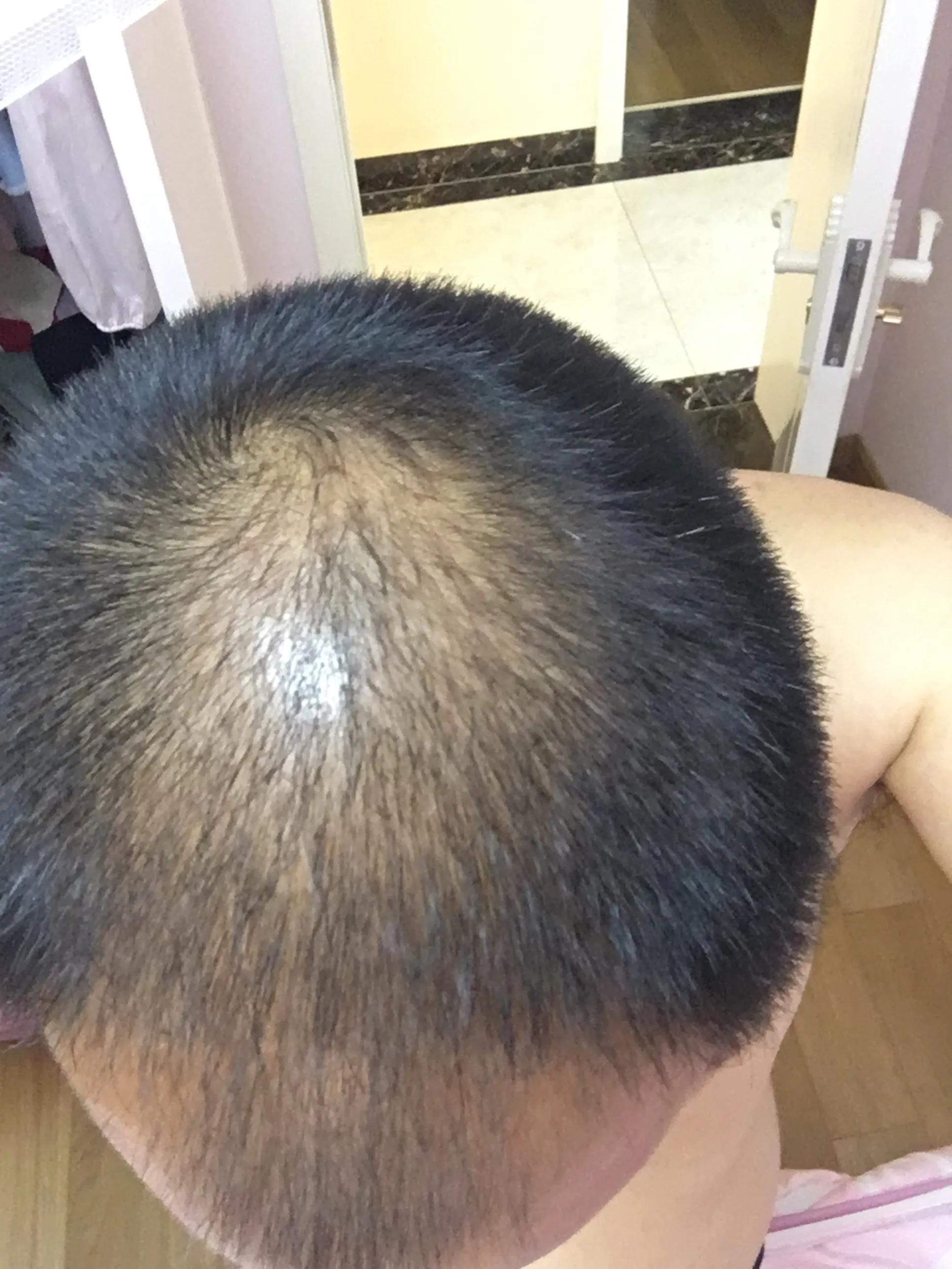 有谁治好了脂溢性脱发,脂溢性脱发用什么洗头