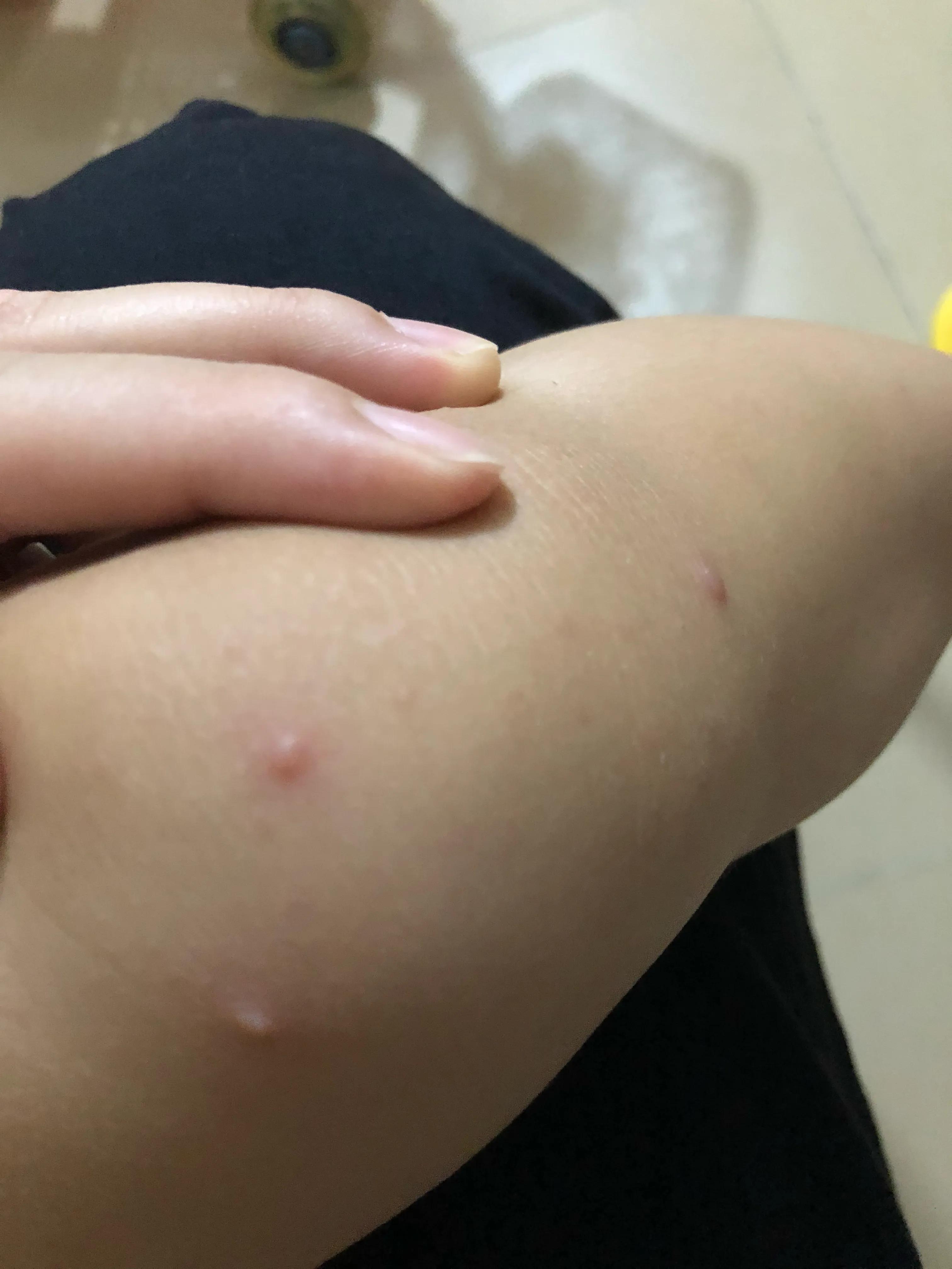 十一假期来临手足口病高发,90天宝宝会得手足口病吗