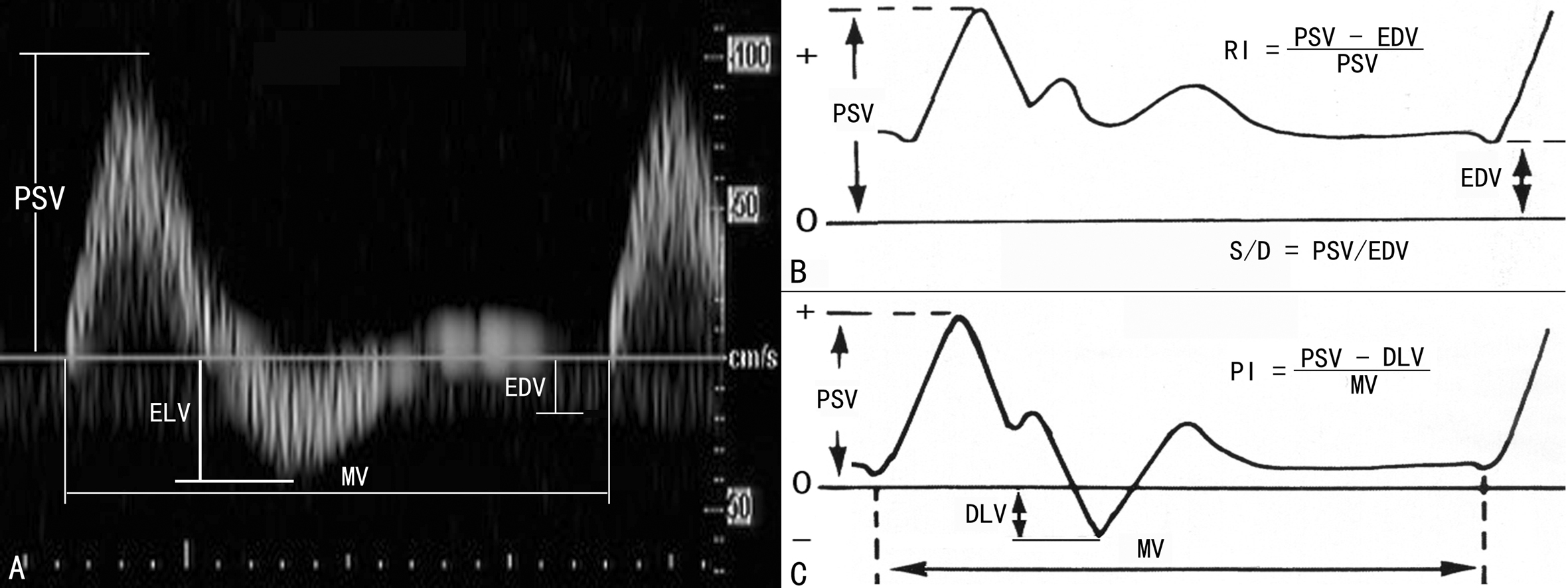 孕期彩色多普勒超声怎么看,多普勒超声检查孕期报告单怎么看