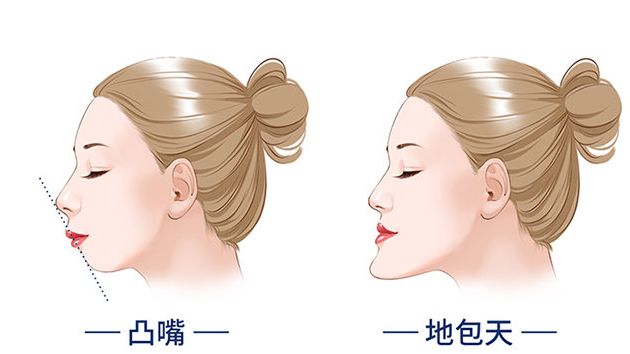 正畸日记补牙,正畸刚戴上牙套的不适应有哪些