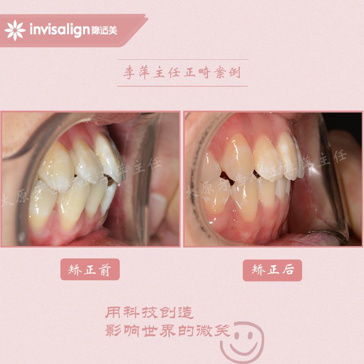 太原矫正牙齿需要做正颌吗,太原牙齿二次矫正