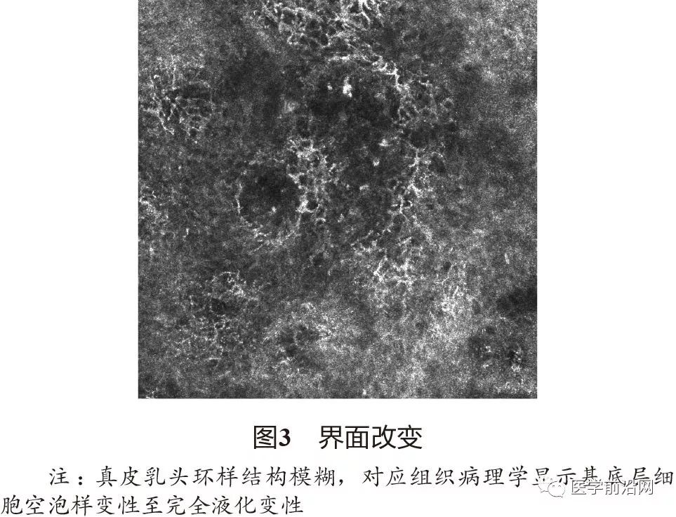 炎症性皮肤病反射式共聚焦显微镜诊断特征专家共识全文发布