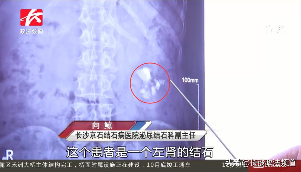 长沙男子尝试气功治结石，结果反致肾脏积水