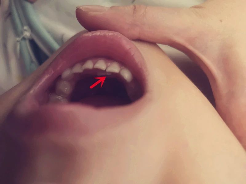 小孩口腔最里面有双排牙,孩子嘴里出了好多牙