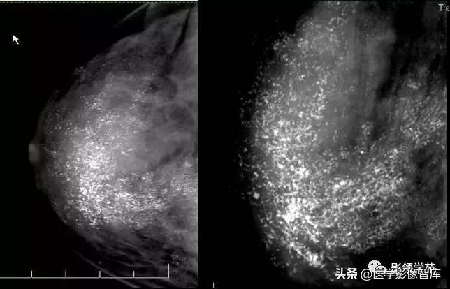 乳腺钙化怎么区分良性和恶性,乳腺钙化的诊断与分级