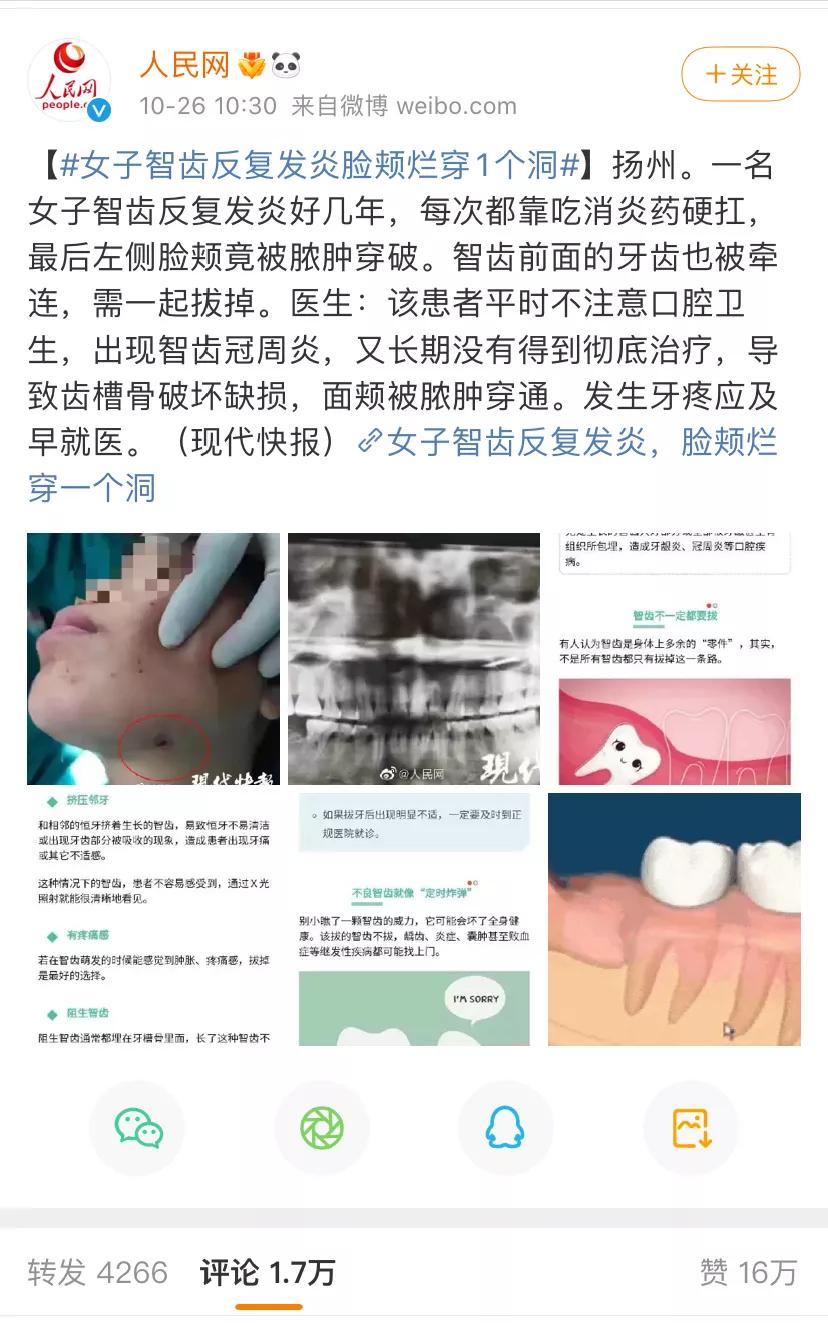 女子智齿烂脸,智齿发炎的真实案例