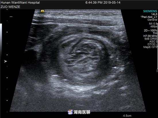 宝宝半夜腹痛呕吐什么原因,宝宝哭闹恶心干呕怎么回事