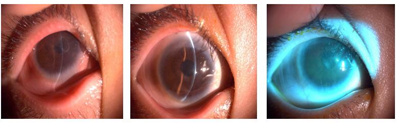 过敏性结膜炎眨眼睛很严重,眼角奇痒无比是角膜炎还是结膜炎