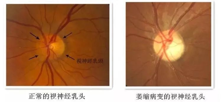 视神经萎缩老中医偏方,视神经萎缩视野缺失是什么症状