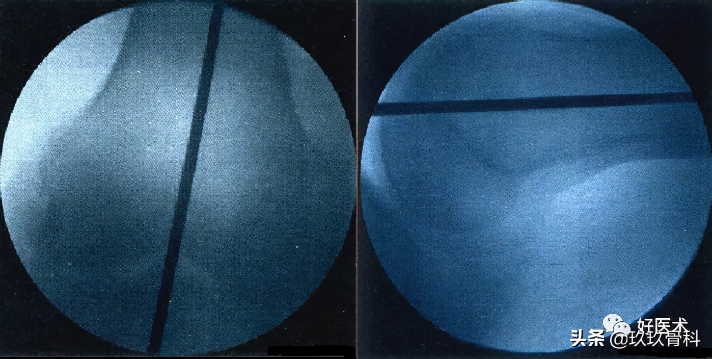 髓内钉技巧,髓内钉教学视频讲解