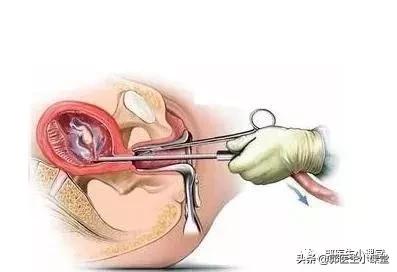 意外怀孕药流过程吃什么药,意外怀孕药流和人流哪个伤害小