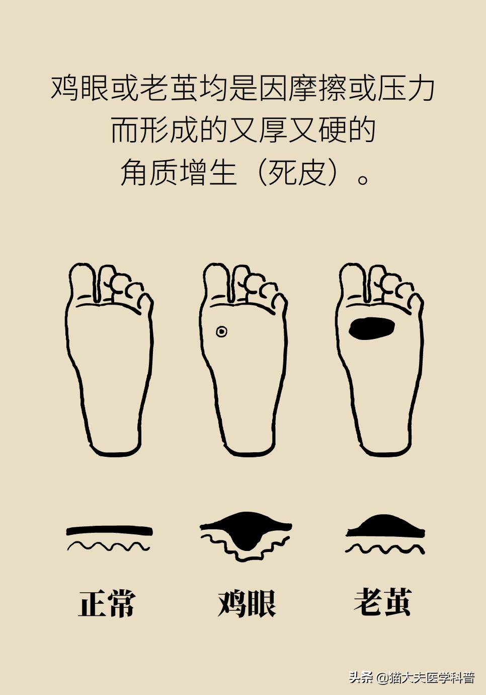 鸡眼好了长了一层老茧,鸡眼与老茧的区别图片